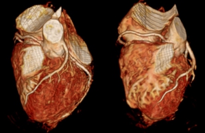 心臓の血管を 3D で評価します。
